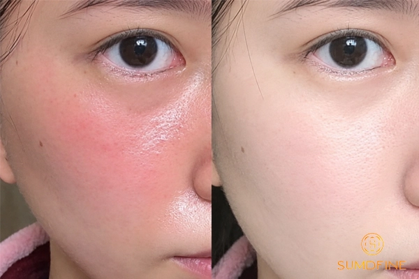 Vì sao da mặt bị đau rát như bị bỏng? Phải làm sao để xử lý hiệu quả? 7 Chăm sóc da trong thời gian phục hồi