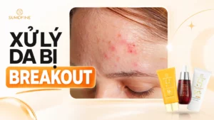 Cách xử lý khi da bị breakout bùng mụn ồ ạt