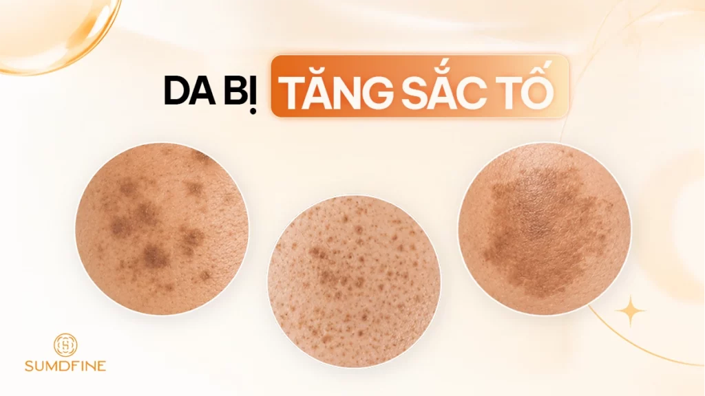 Da bị tăng sắc tố