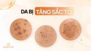 Da bị tăng sắc tố