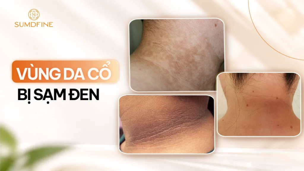 Da vùng cổ bị sạm đen: Nguyên nhân & 3 cách xử lý hiệu quả 1 Da cổ bị đen sạm là do đâu?