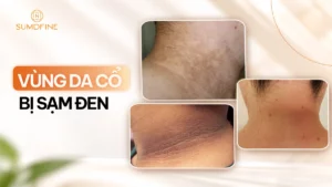 Da cổ bị đen sạm là do đâu?