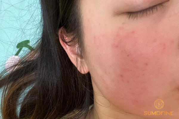 Vì sao da mặt bị đau rát như bị bỏng? Phải làm sao để xử lý hiệu quả? 2 Da đau rát, nóng, nhạy cảm như bị bỏng là tình trạng gì