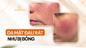 Da mặt đau rát như bị bỏng