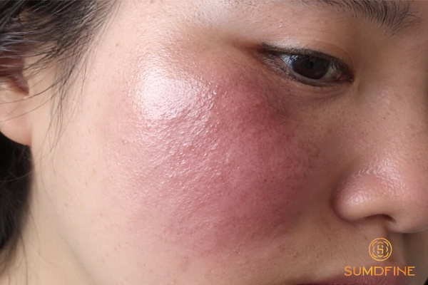 Vì sao da mặt bị đau rát như bị bỏng? Phải làm sao để xử lý hiệu quả? 4 Dị ứng mỹ phẩm khiến da sưng, ngứa rát và giống như bỏng