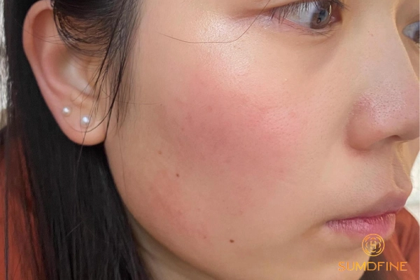 Vì sao da mặt bị đau rát như bị bỏng? Phải làm sao để xử lý hiệu quả? 3 Dùng hoạt chất treatment khiến da dễ bị bỏng rát