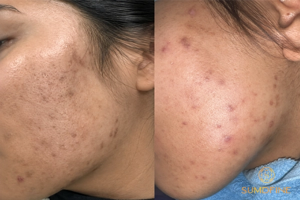 Dùng kem bôi trị tăng sắc tố