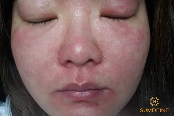Vì sao da mặt bị đau rát như bị bỏng? Phải làm sao để xử lý hiệu quả? 8 Trường hợp cần đến gặp bác sĩ da liễu