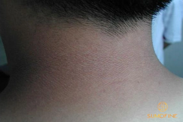 Da vùng cổ bị sạm đen: Nguyên nhân & 3 cách xử lý hiệu quả 2 Không chống nắng đầy đủ có thể khiến da cổ đen sạm