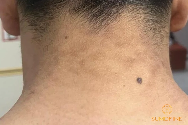 Da vùng cổ bị sạm đen: Nguyên nhân & 3 cách xử lý hiệu quả 4 Nấm da hoặc lang ben cũng có thể khiến da cổ không đều màu
