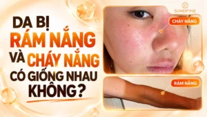 Rám nắng và cháy nắng